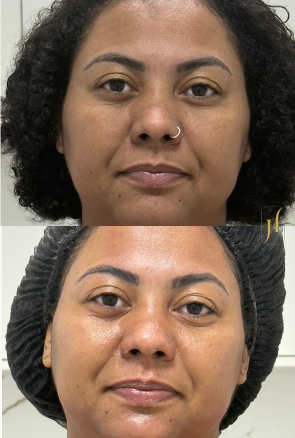 Antes e depois real de tratamento facial